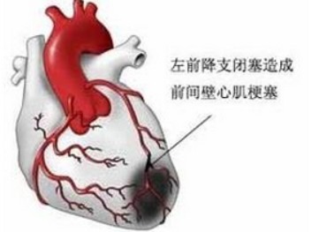 心肌梗塞的前兆是什么：心肌梗塞做什么检查可以查出来