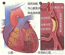 心肌梗塞的前兆是什么：心肌梗塞做什么检查可以查出来
