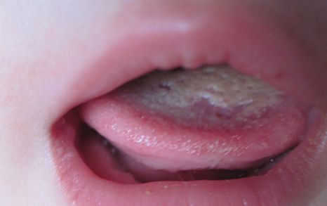 舌头发白是什么病引起的：舌头发白吃什么调理好