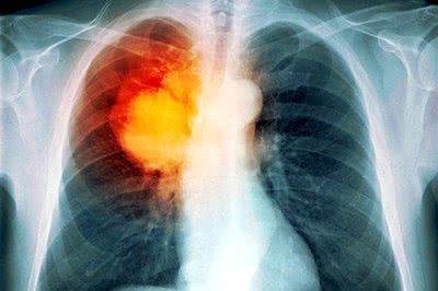 肺癌的早期主要症状是什么（容易生病/体重下降/手指疼痛）