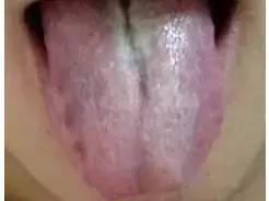 舌头中间有裂纹是怎么回事（舌头中间有裂纹正常吗）